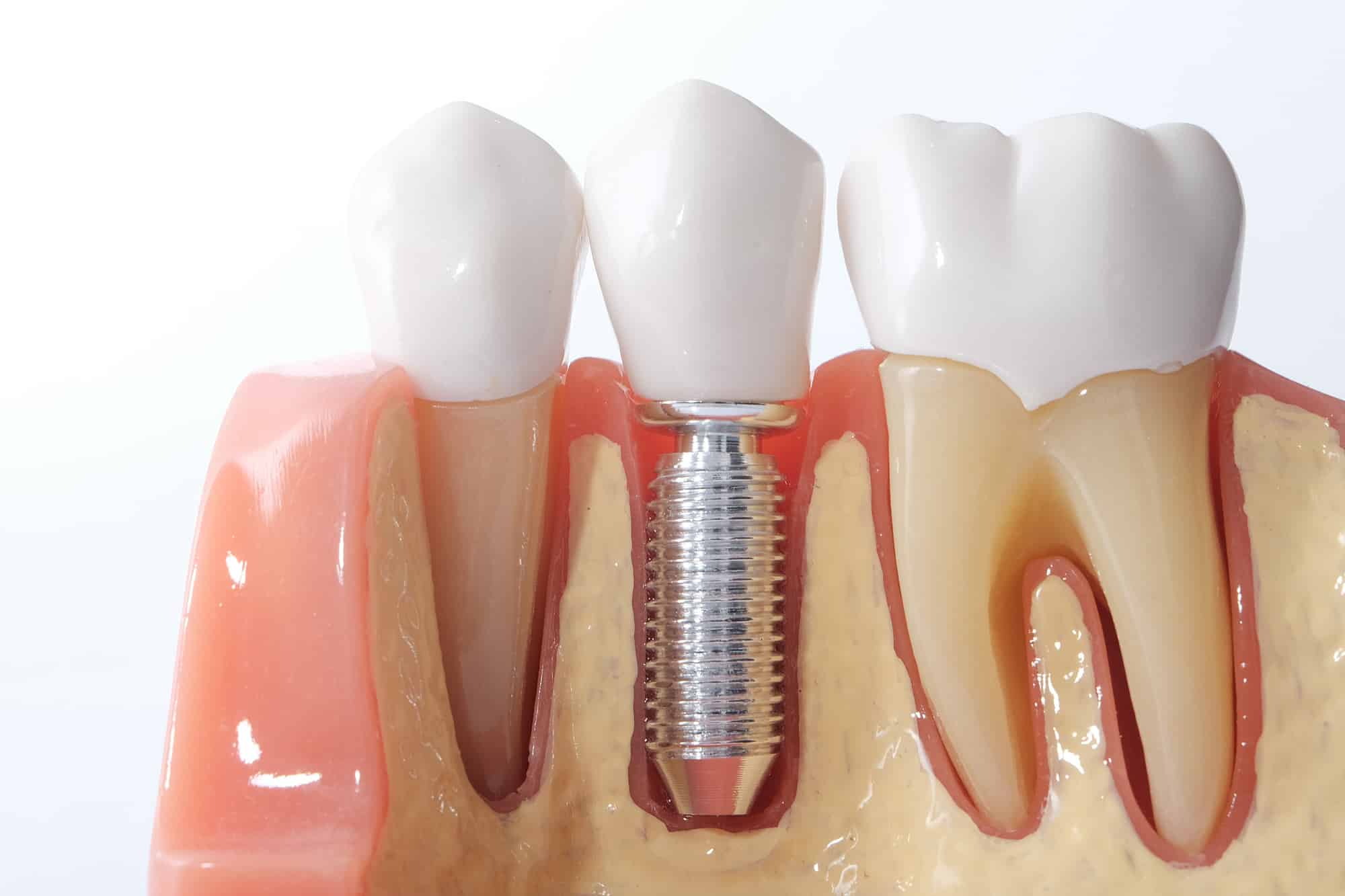 What Are Mini Implants For Teeth