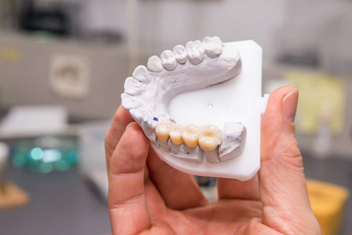 how-long-does-a-dental-bridge-last