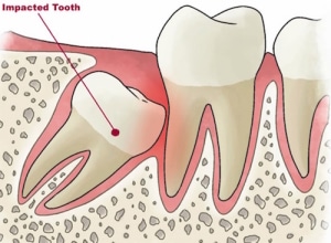 Impacted Teeth