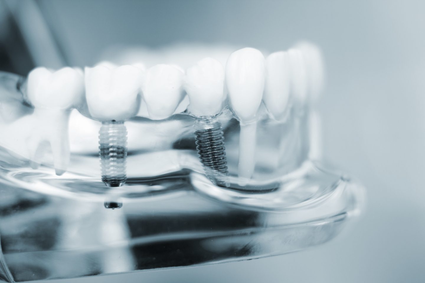 All on 4 Dental Implants vs. Traditional Implants: What’s the Difference?