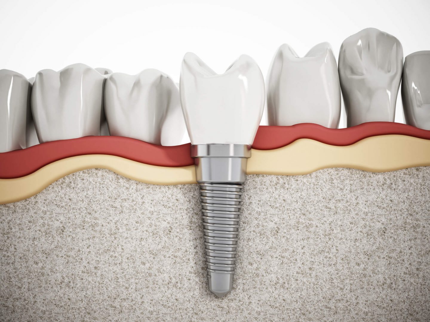 How Long Do Dental Implants Last on Average?